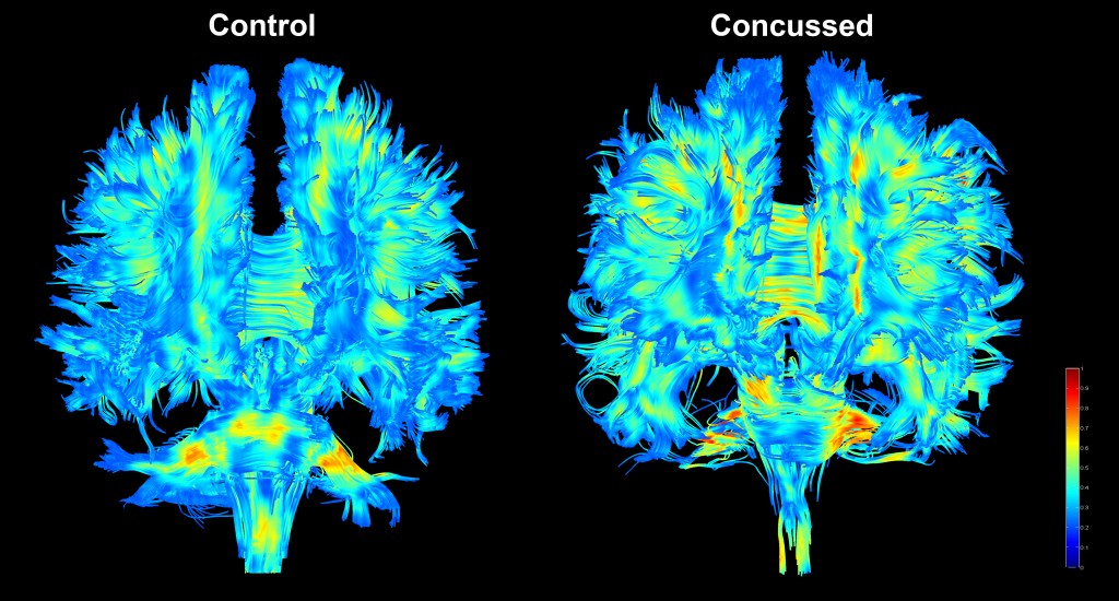 WholeBrainTractography_concussion_900dpi